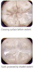 sealant